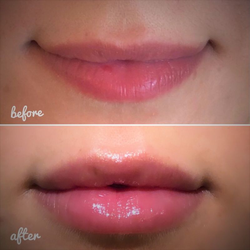 Bowling Green Botox & Juvederm | Precision Dental